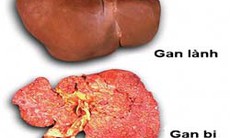 Không chủ quan với bệnh u gan