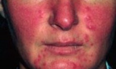 Nhận diện bệnh rosacea gây mất thẩm mỹ