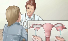 Nguy hại của bệnh đa nang buồng trứng