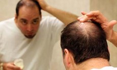 Nhận diện thủ phạm gây chứng rụng tóc