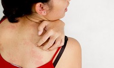 Dị ứng nghiêm trọng do thuốc Đông y