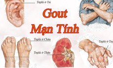 Có thể trị dứt điểm sỏi do gút?