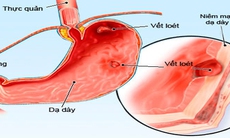 Trị tận gốc bệnh dạ dày, cần tuân thủ nguyên tắc gì?