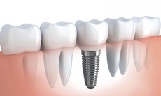 Phòng viêm nhiễm sau phục hình răng bằng cấy ghép implant