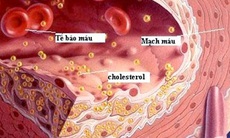 Tác dụng phụ của statin trị mỡ máu: Cân nhắc lợi ích và nguy cơ khi dùng