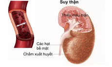 Cảnh giác thuốc gây tổn thương thận cấp tính