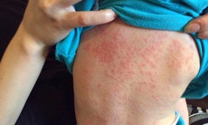 Hiểu rõ để chặn nguy biến do sởi