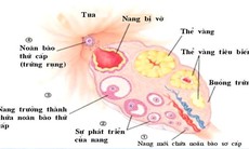 Rối loạn phóng noãn cản trở quá trình thụ thai tự nhiên