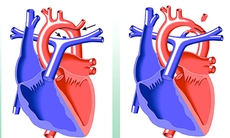 Hẹp eo động mạch chủ: Một dị tật dễ bị bỏ sót