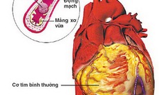 Hút thuốc lá và bệnh tim mạch