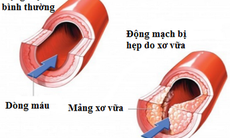 Ngừa mảng bám xơ vữa động mạch