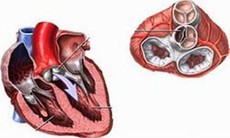 Mô hình van tim 3D: Giải pháp mới an toàn khi thay van động mạch chủ qua ống thông