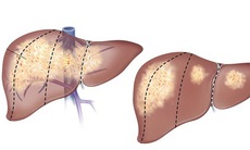 Xơ gan nguy hiểm thế nào?