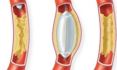 Làm gì khi động mạch vành bị canxi hóa?