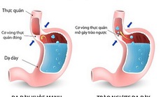 Trị đau tức ngực do trào ngược dạ dày - thực quản, thuốc gì?