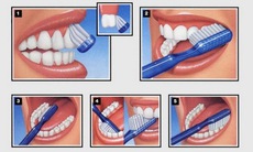 Nhận biết và xử trí viêm lợi cấp