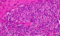 Hội chứng carcinoid có nguy hiểm?