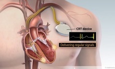 Cải tiến máy tạo nhịp tim, tăng cơ hội thành công khi cấy ghép