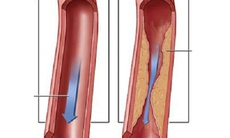 Hẹp động mạch vành, khi nào là nguy hiểm?