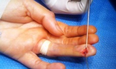 U cuộn mạch búp ngón tay - Tổn thương hiếm gặp