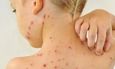 Hạn chế các biến chứng của bệnh thủy đậu