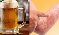Bia, rượu khiến bệnh dị ứng đa dạng, phức tạp