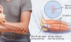 Nhận biết bệnh viêm gân