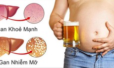 Nguyên nhân và cách phòng ngừa gan nhiễm mỡ