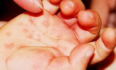Virut gây bệnh tay - chân - miệng ở Việt Nam chưa thay đổi kiểu gene
