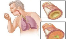 Một số bệnh dễ nhầm với lao phổi