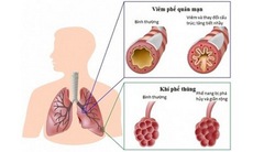 Bệnh phổi tắc nghẽn mạn tính - “Sát thủ vô hình”