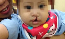 Phẫu thuật nhân đạo cho 50 trẻ có khe hở môi- vòm miệng