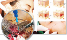 Chuyên gia khuyến cáo: Nhiều biến chứng sau làm đẹp bằng... chôn chỉ