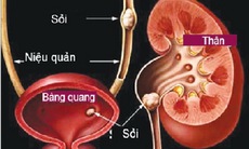 Bài thuốc điều trị sỏi tiết niệu