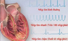 Bài thuốc chữa trị nhịp tim chậm