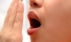 Viêm amidan có gây hôi miệng?