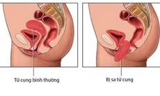 Bệnh sa sinh dục: Những điều cần biết