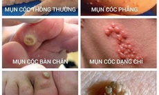 Mụn cóc: Điều trị sớm để tránh lây lan