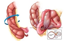 Nhận biết sớm xoắn đại tràng, tránh nguy biến