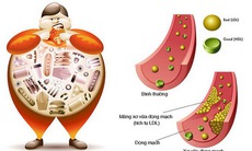 Tăng mỡ máu và cách kiểm soát