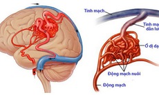 Dị dạng mạch não: Bệnh nguy hiểm, dễ nhầm lẫn