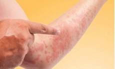 Làm thế nào để phát hiện sớm ung thư da?