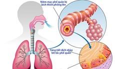 Bệnh đường hô hấp dễ mắc trong mùa nóng: Các biện pháp phòng ngừa