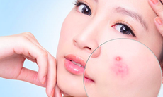 Bài thuốc trị mụn nhọt