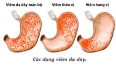 Điều trị viêm hang vị dạ dày