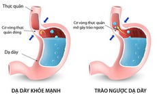 Bài thuốc trị bệnh trào ngược dạ dày - thực quản