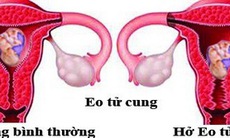 Bệnh dễ gây sẩy thai ít người biết