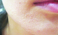 Xử trí dị ứng mỹ phẩm