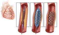 Lần đầu tiên tại ĐBSCL thực hiện kỹ thuật khó trong đặt stent mạch vành