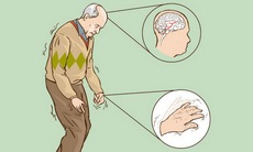 Khắc phục bất lợi khi dùng levodopa trị Parkinson